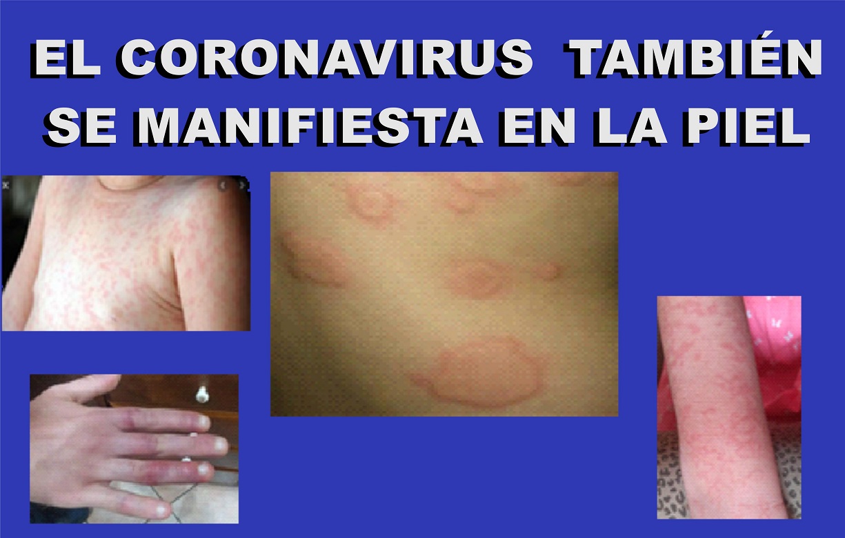 El síndrome del ‘dedo congelado’ y alteraciones cutáneas. Un nuevo síntoma del coronavirus.