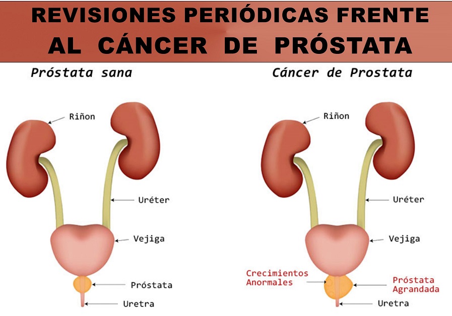 Las revisiones periódicas en los hombres son esenciales frente al cáncer de próstata.